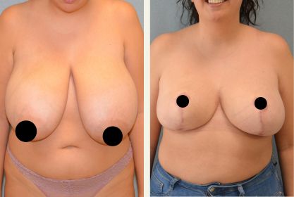 Före- och efterbild på bröstförminskning med bröstlyft på Estetikcentrum