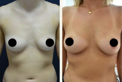 Före- och efterbild på kvinna som gjort en bröstförstoring med eget kroppsfett på Estetikcentrum