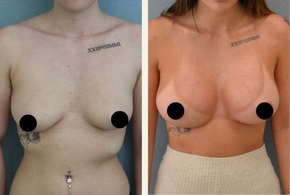 Före- och efterbild på bröstförstoring med implantat på Estetikcentrum