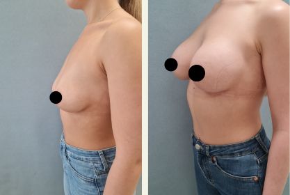 Före- och efterbild på bröstförstoring med implantat på Estetikcentrum