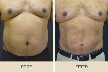 Före och efter bilder på man efter fettsugning utförd på Estetikcentrum