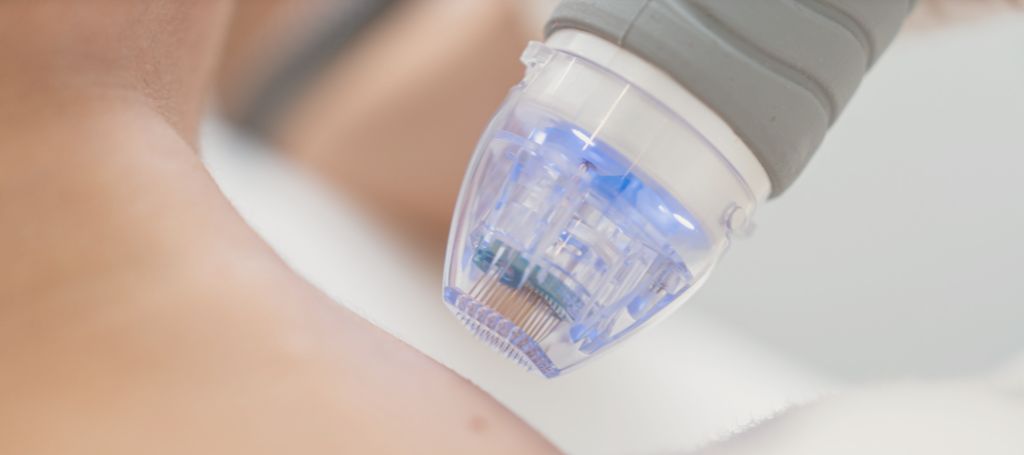 Närbild på microneedling