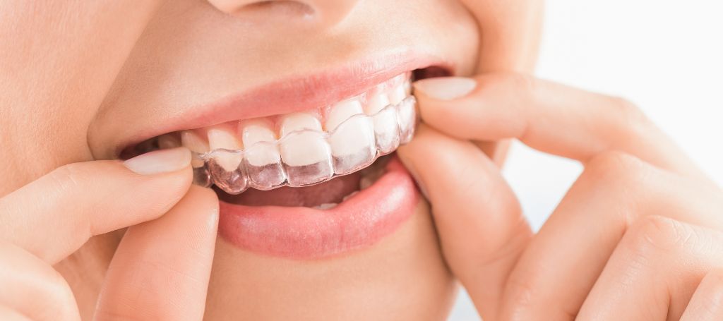 Osynlig tandställning från Invisalign