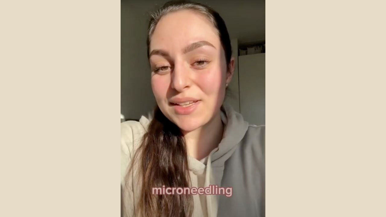 Patient berättar om microneedling på Estetikcentrum