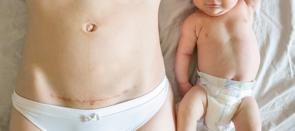 Mommy Makeover Sverige – Återfå din kropp efter graviditet