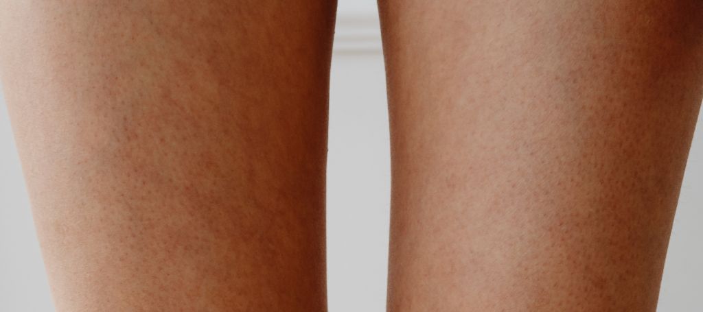 Lårplastik före och efter bilder – Upptäck de synliga förändringarna efter en lårplastikoperation